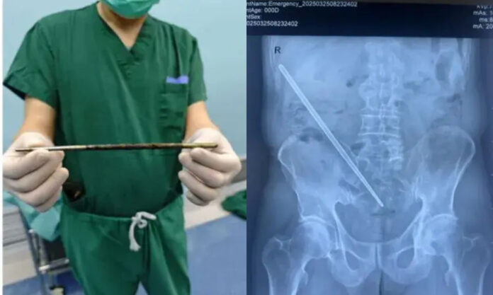 The Nanjinger - Man Discovered with 25CM Long Chopsticks in his Butt for 3 years!