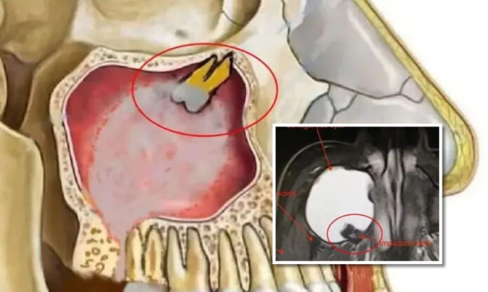 The Nanjinger - Woman’s Wisdom Tooth Grows under Her Eye Socket in Yangzhou