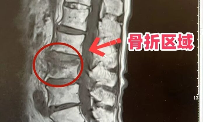 The Nanjinger - 104 Year Old Man Walks out of Hospital Hours after Spine Surgery in Nantong