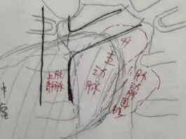 The Nanjinger - 11cm Tumour in Woman’s Mediastinum; Nanjing Medical University Steps in