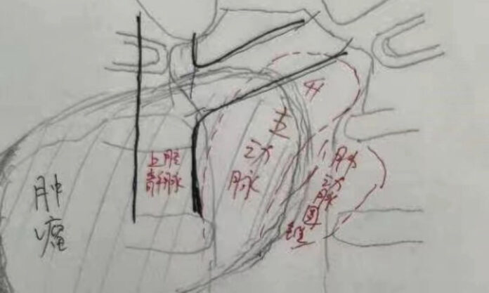 The Nanjinger - 11cm Tumour in Woman’s Mediastinum; Nanjing Medical University Steps in