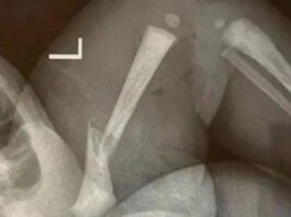 The Nanjinger - Newborn with Fractured Leg Result of Medical Malpractice by Hospital in Taizhou