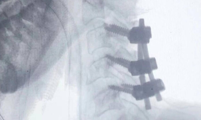 The Nanjinger - Woman in Yangzhou with Broken Neck has Nails Drilled into Cervical Vertebrae