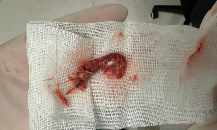 The Nanjinger - Entire Shrimp Stuck in Lung of 60 Year Old Man in Changzhou