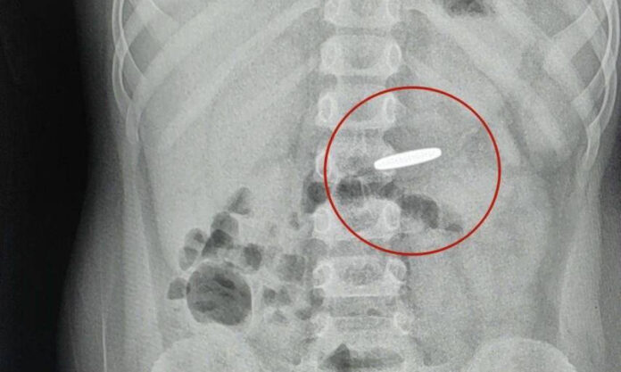 The Nanjinger - 4 YO Child Swallows ¥1 Coin in Yangzhou; Doctors Take Just 3 Minutes to Remove it