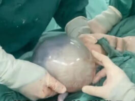The Nanjinger - Baby Born in a Shell in Xuzhou Lifts Veil of Nature; Doctors in Tears
