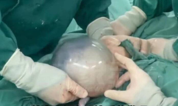 The Nanjinger - Baby Born in a Shell in Xuzhou Lifts Veil of Nature; Doctors in Tears